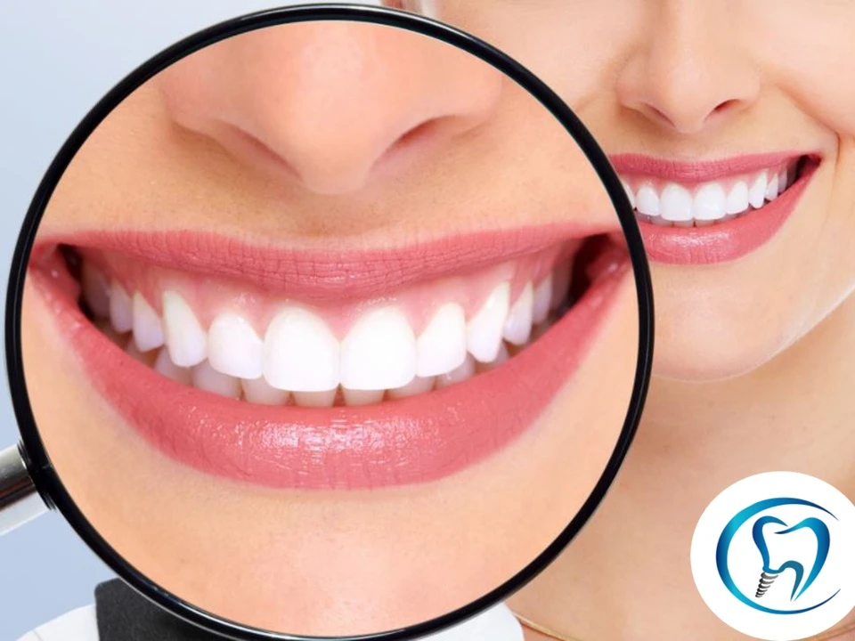 Clareamento dental Cotidente