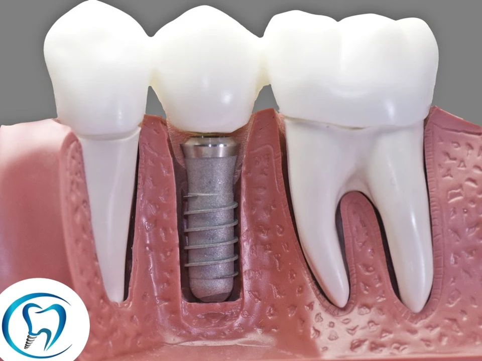 Implantes unitário Cotidente