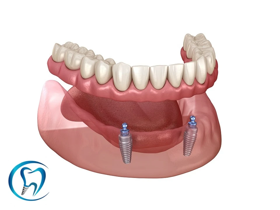 Prótese overdenture Cotidente