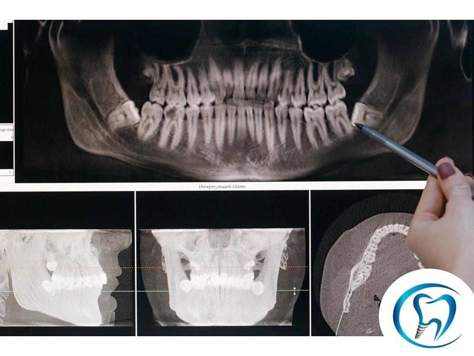 Cirurgia de siso Cotidente